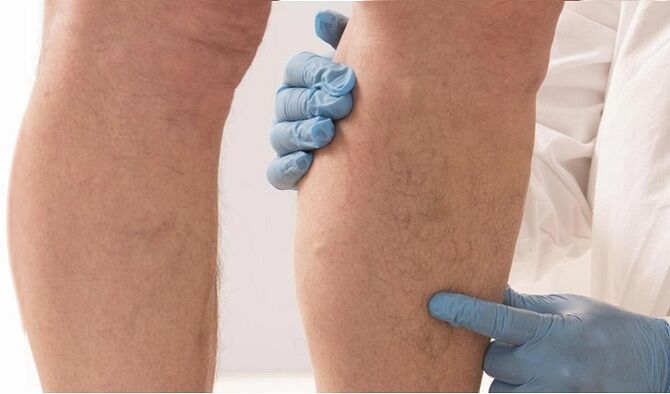 Doctors recommend Varicone to treat varicose veins