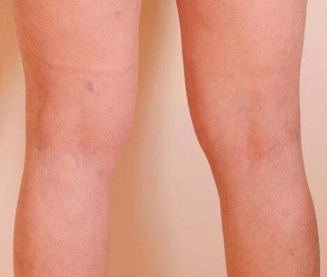 Varicone Get rid of varicose veins