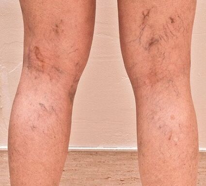 Varicose veins appear on the legs