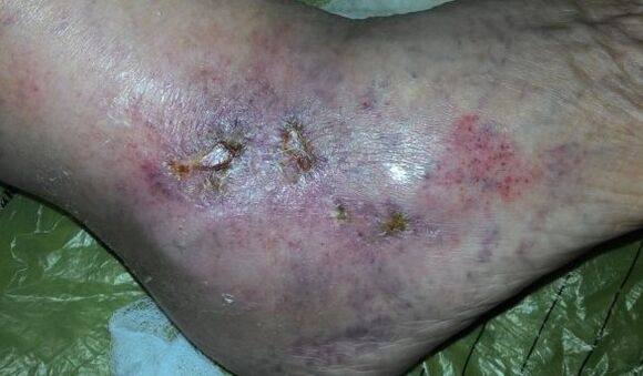 Complications of varicose veins
