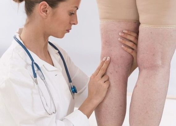 Diagnosis of varicose veins