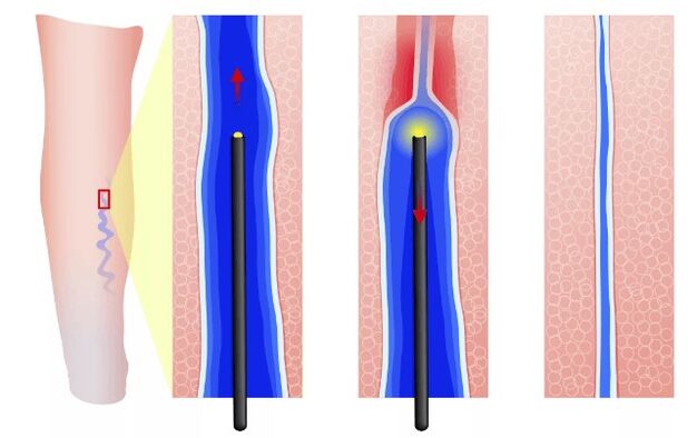 Inner tail electrocondensation