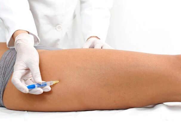 Treatment of varicose veins