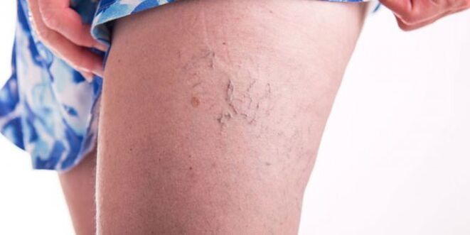 Varicose veins on the legs