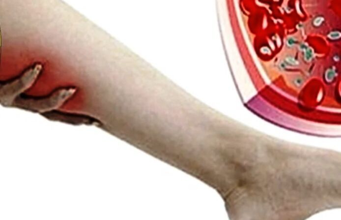 Varicocele on the legs