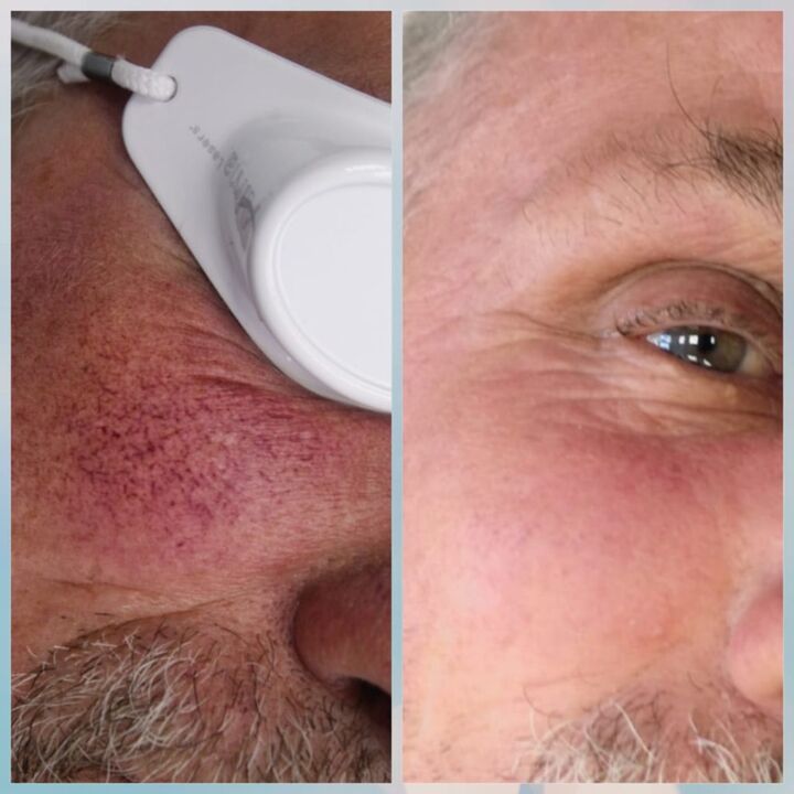 Varicocele on the face
