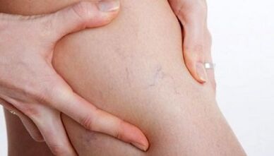 How to show leg veins on the legs