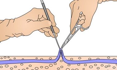Varicocele operation