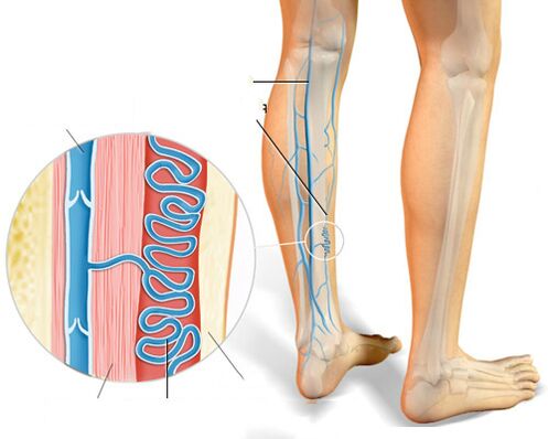 Clinical manifestations of varicose veins
