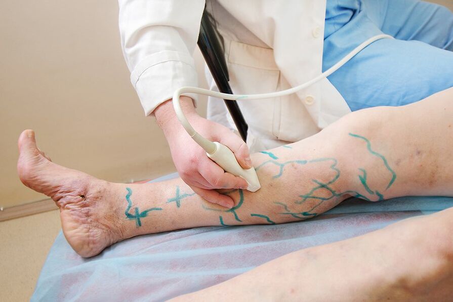 Preparation for venous resection - marking perforators in the leg for ultrasound scan