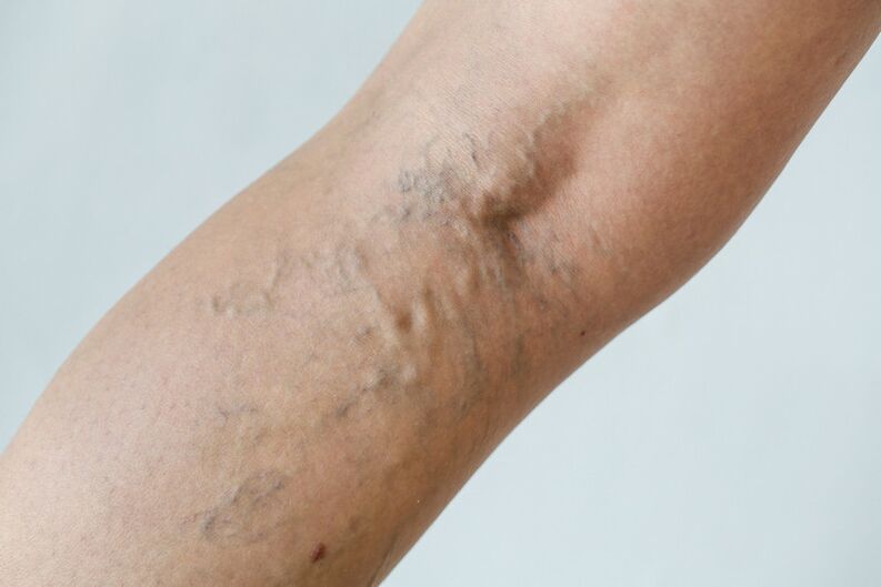Stage C2 – Popliteal varices (Thierry perforators) and reticular veins