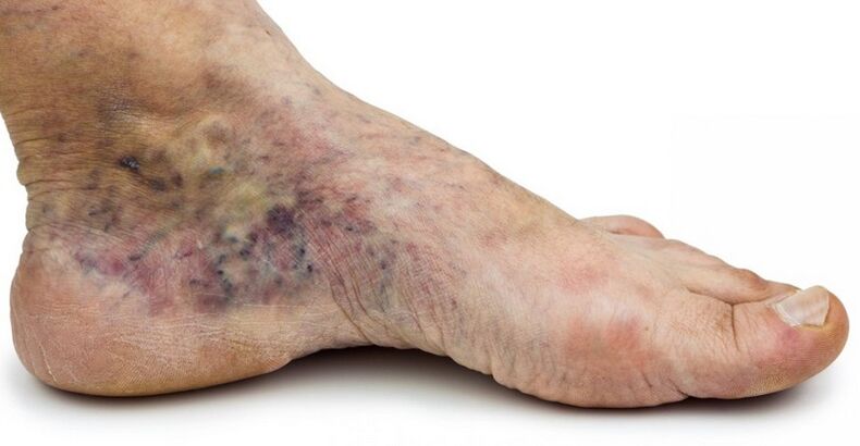 Stage C4c – Crown of Foot, Central Phlebitis
