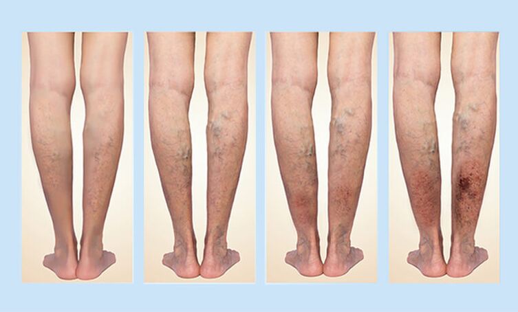 The stage of varicose veins